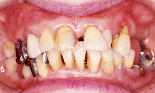 義歯・入れ歯　治療例