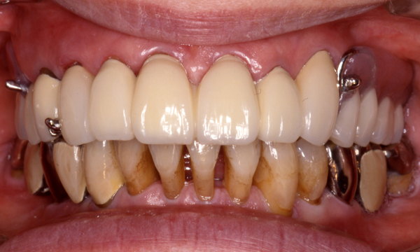 義歯・入れ歯　治療例