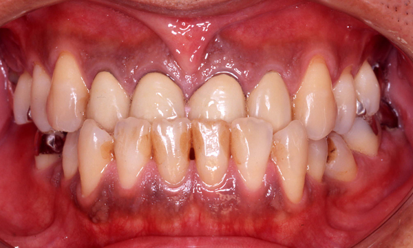 歯牙移植　症例