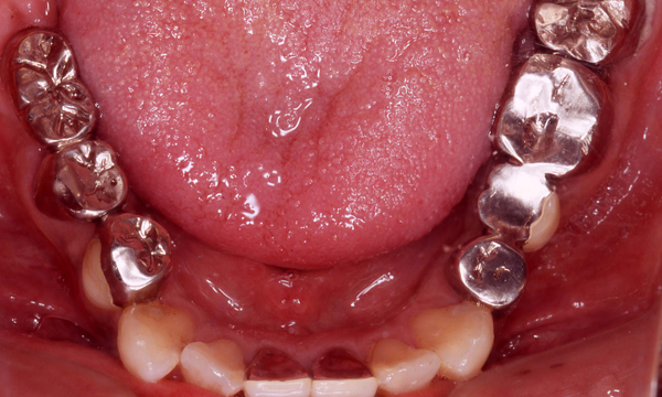 歯牙移植　症例